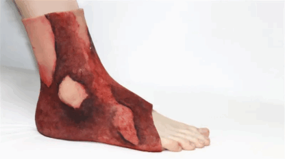 Ankle Sleeve with Burn Wounds – Ayak bileği 3. derece yanık eğitim modeli